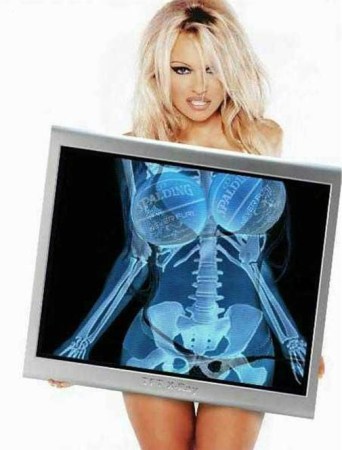 Pam_Anderson_s_X-ray