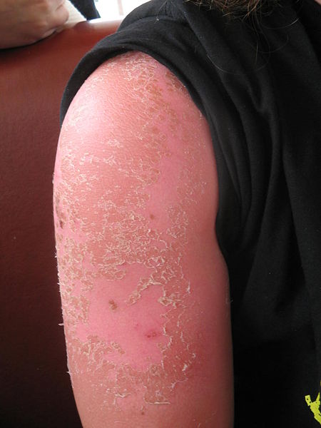 Sun_burn
