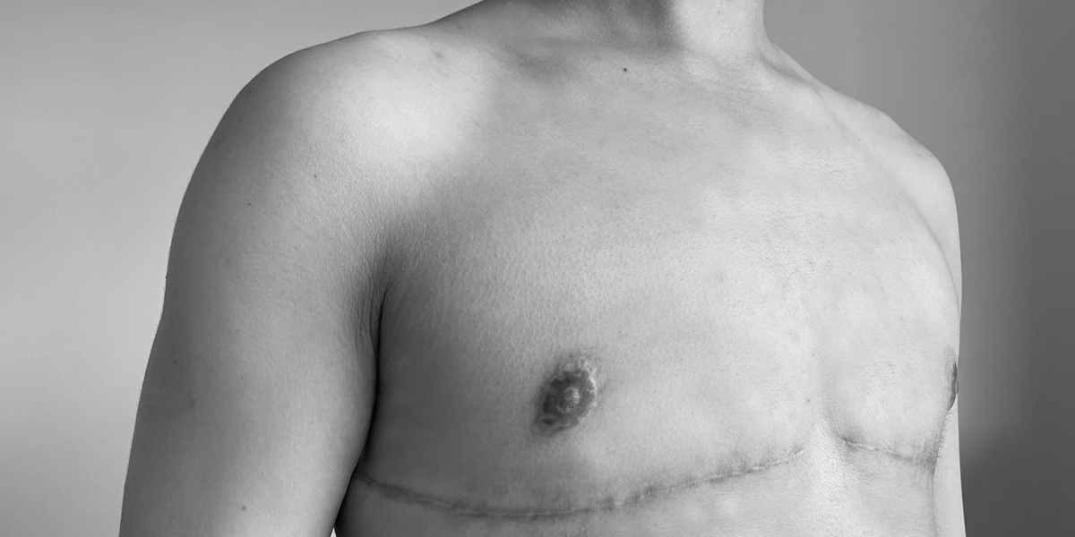 a black and white photo of a person's chest and thin lines of scars beneath their nipples let behind after top surgery