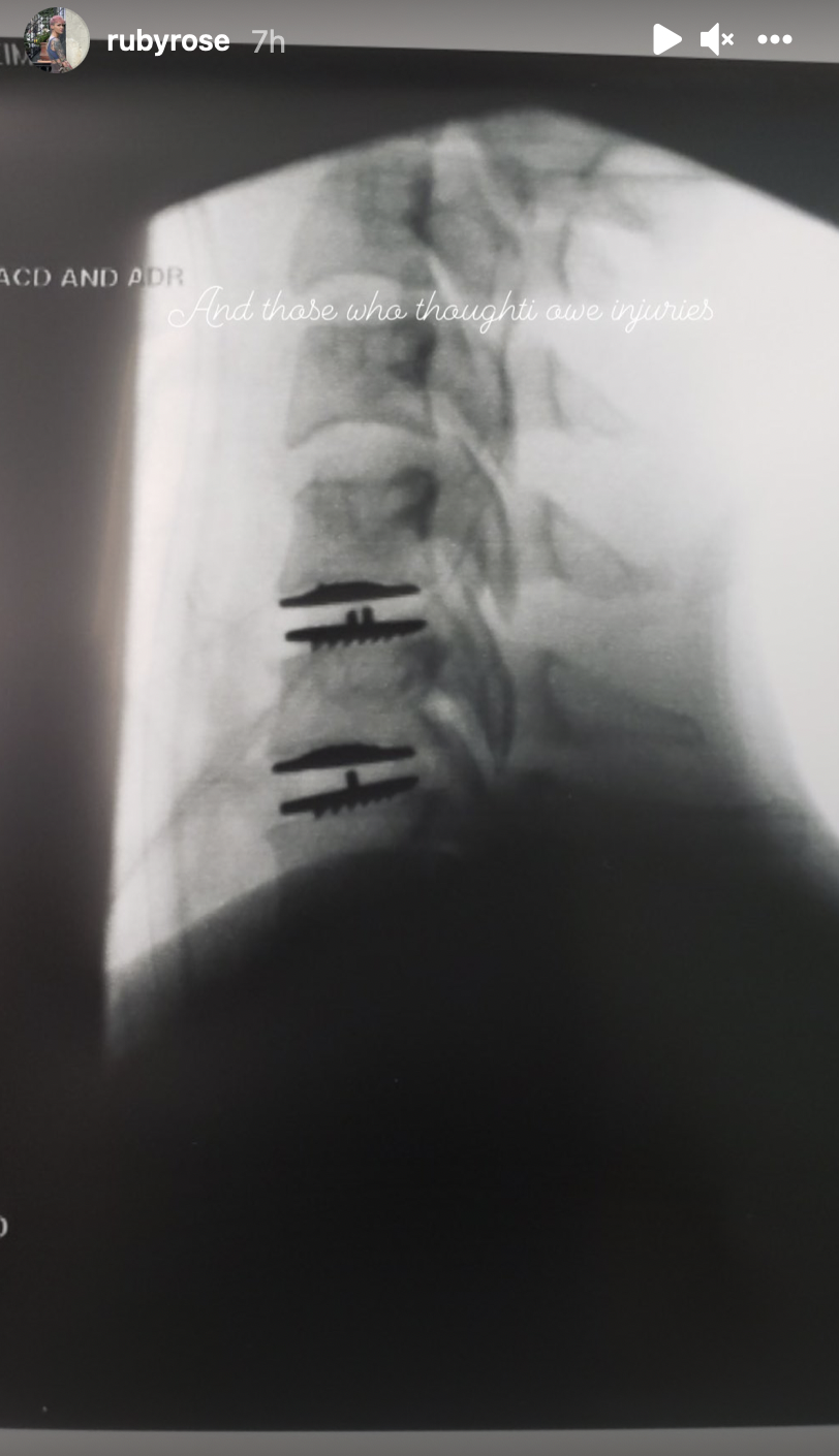 Screenshot of Ruby Rose's x-rays, from their Instagram Live