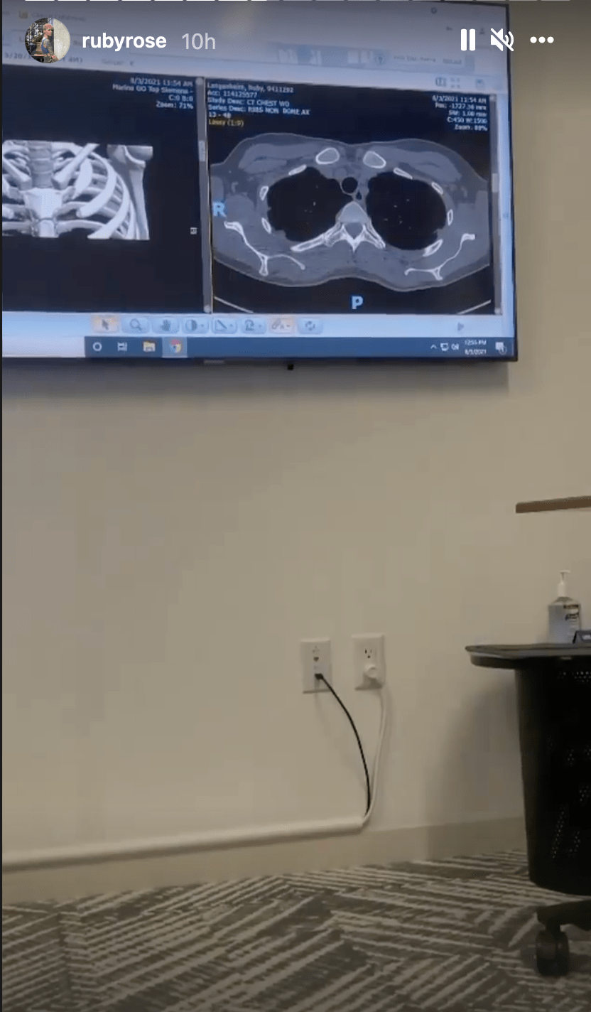 4 Video of Ruby Rose's spinal surgery