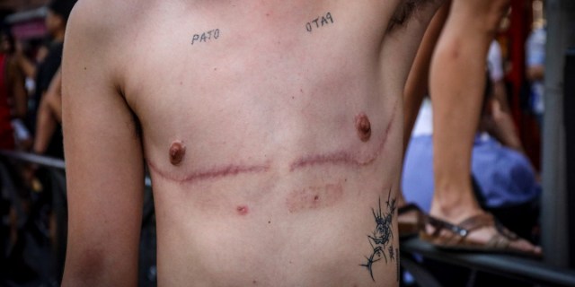 A trans masculine person showing their post-surgery scars.