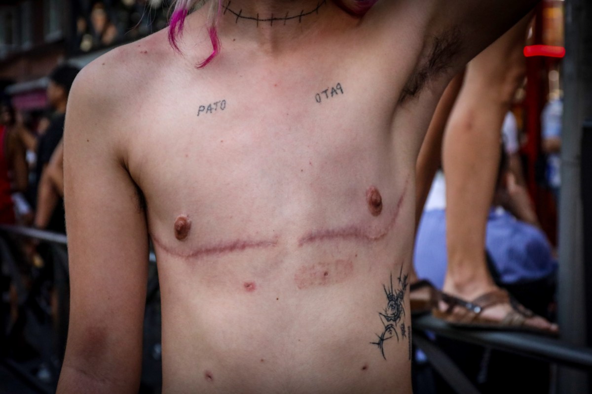 A trans masculine person showing their post-surgery scars.