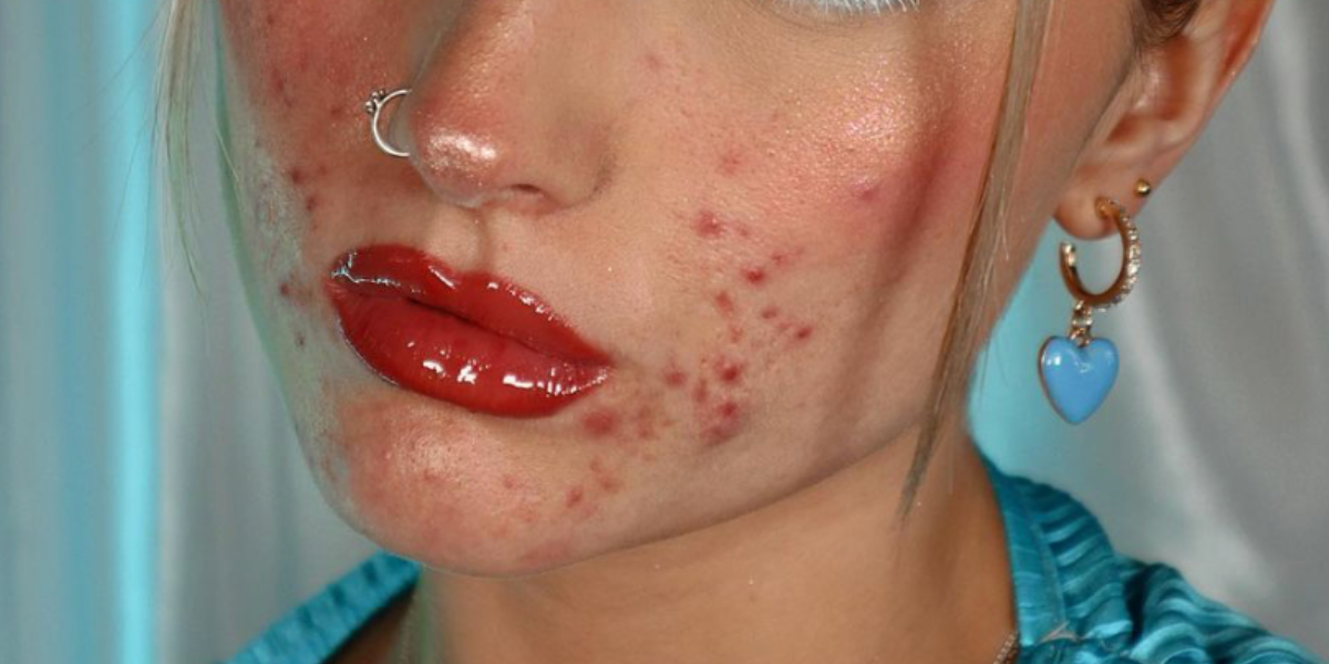 Acne positivity: a close up of Izzie Rodger's lips with bright glossy red lipstick acne on her cheeks