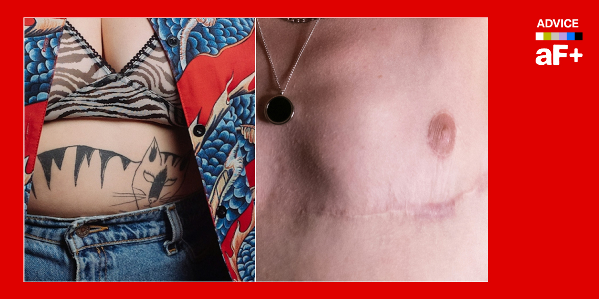 someone pre and post top surgery